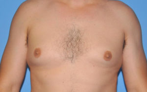 Gynecomastia Before and After Pictures Plano, TX