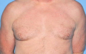 Gynecomastia Before and After Pictures Plano, TX