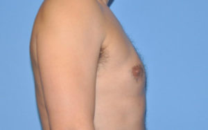 Gynecomastia Before and After Pictures Plano, TX