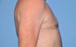 Gynecomastia Before and After Pictures Plano, TX