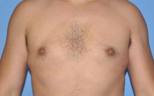 Gynecomastia Before and After Pictures Plano, TX