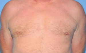 Gynecomastia Before and After Pictures Plano, TX