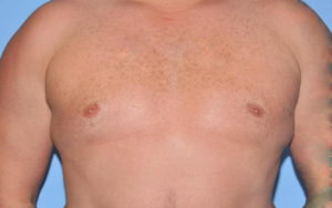 Gynecomastia Before and After Pictures Plano, TX