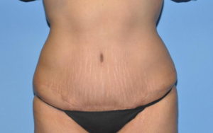 Tummy Tuck Before and After Pictures Plano, TX