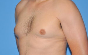 Gynecomastia Before and After Pictures Plano, TX