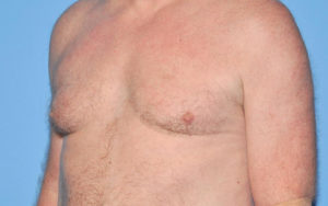 Gynecomastia Before and After Pictures Plano, TX