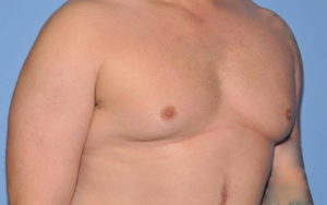 Gynecomastia Before and After Pictures Plano, TX