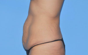 Tummy Tuck Before and After Pictures Plano, TX