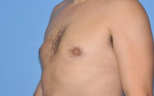 Gynecomastia Before and After Pictures Plano, TX