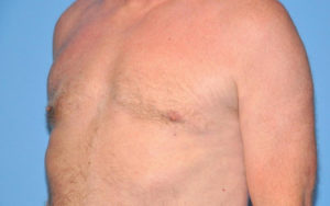 Gynecomastia Before and After Pictures Plano, TX