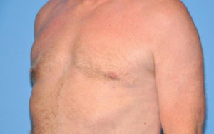 Gynecomastia Before and After Pictures Plano, TX
