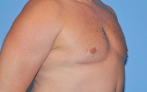 Gynecomastia Before and After Pictures Plano, TX