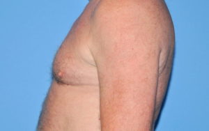 Gynecomastia Before and After Pictures Plano, TX