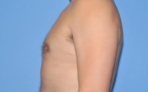 Gynecomastia Before and After Pictures Plano, TX