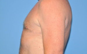 Gynecomastia Before and After Pictures Plano, TX