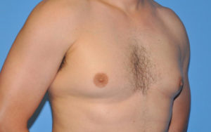 Gynecomastia Before and After Pictures Plano, TX