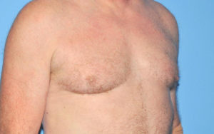 Gynecomastia Before and After Pictures Plano, TX