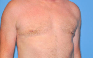 Gynecomastia Before and After Pictures Plano, TX