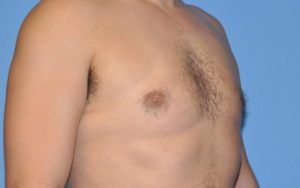 Gynecomastia Before and After Pictures Plano, TX