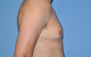 Gynecomastia Before and After Pictures Plano, TX