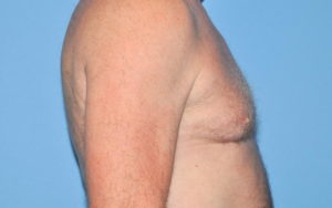 Gynecomastia Before and After Pictures Plano, TX