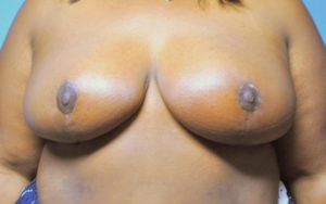 Breast Reduction Before and After Pictures Plano, TX