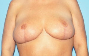 Breast Reduction Before and After Pictures Plano, TX