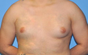 Gynecomastia Before and After Pictures Plano, TX
