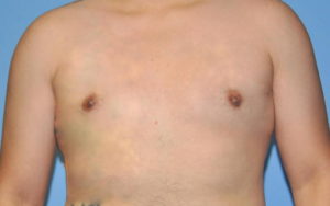 Gynecomastia Before and After Pictures Plano, TX