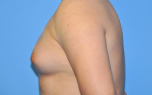 Gynecomastia Before and After Pictures Plano, TX