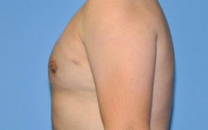 Gynecomastia Before and After Pictures Plano, TX