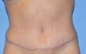 Tummy Tuck Before and After Pictures Plano, TX