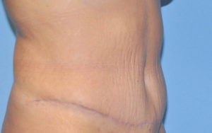 Tummy Tuck Before and After Pictures Plano, TX