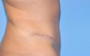 Tummy Tuck Before and After Pictures Plano, TX