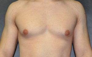 Gynecomastia Before and After Pictures Plano, TX