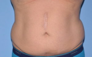 Tummy Tuck Before and After Pictures Plano, TX