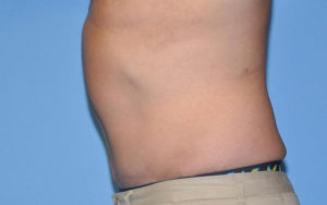 Tummy Tuck Before and After Pictures Plano, TX