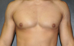 Gynecomastia Before and After Pictures Plano, TX