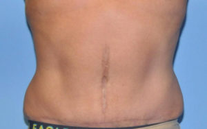 Tummy Tuck Before and After Pictures Plano, TX