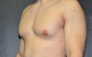 Gynecomastia Before and After Pictures Plano, TX