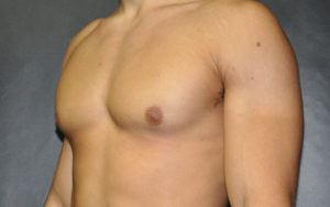 Gynecomastia Before and After Pictures Plano, TX