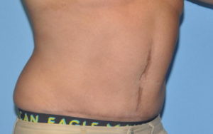 Tummy Tuck Before and After Pictures Plano, TX