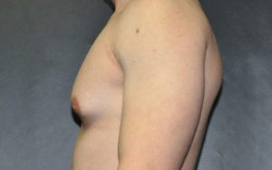 Gynecomastia Before and After Pictures Plano, TX