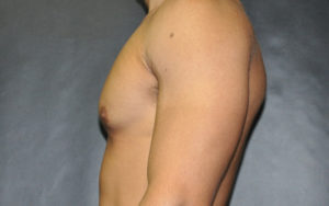 Gynecomastia Before and After Pictures Plano, TX