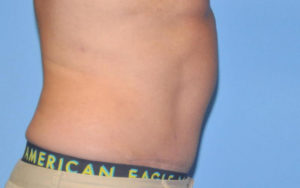 Tummy Tuck Before and After Pictures Plano, TX