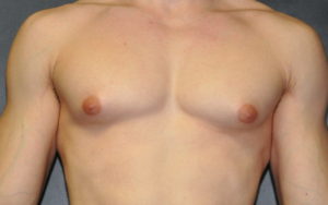 Gynecomastia Before and After Pictures Plano, TX