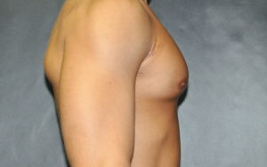 Gynecomastia Before and After Pictures Plano, TX