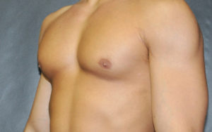 Gynecomastia Before and After Pictures Plano, TX