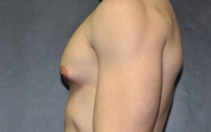 Gynecomastia Before and After Pictures Plano, TX