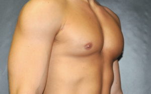 Gynecomastia Before and After Pictures Plano, TX